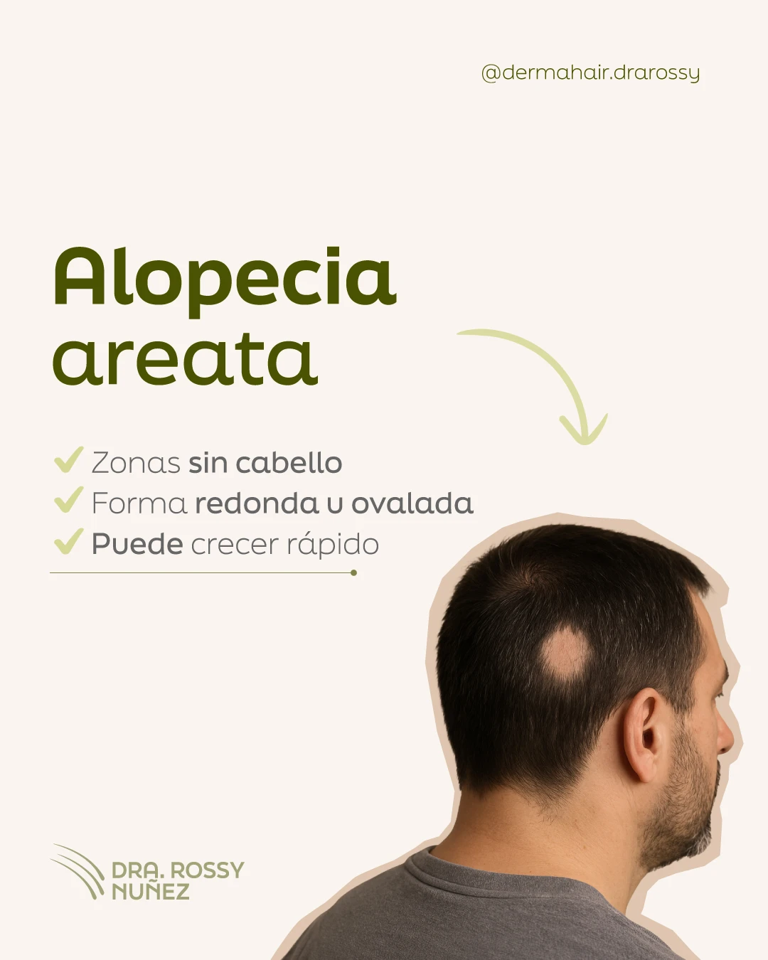Alopecia areata