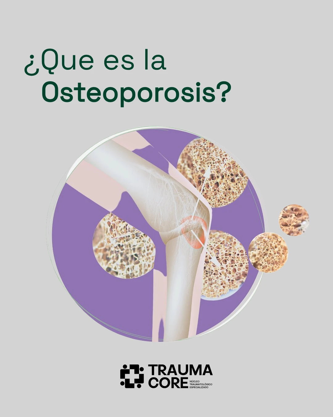 Osteoporosis