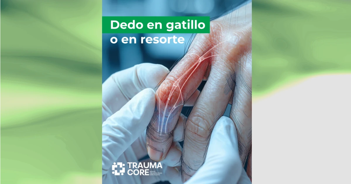 Dedo en gatillo o en resorte: tratamiento en TraumaCore