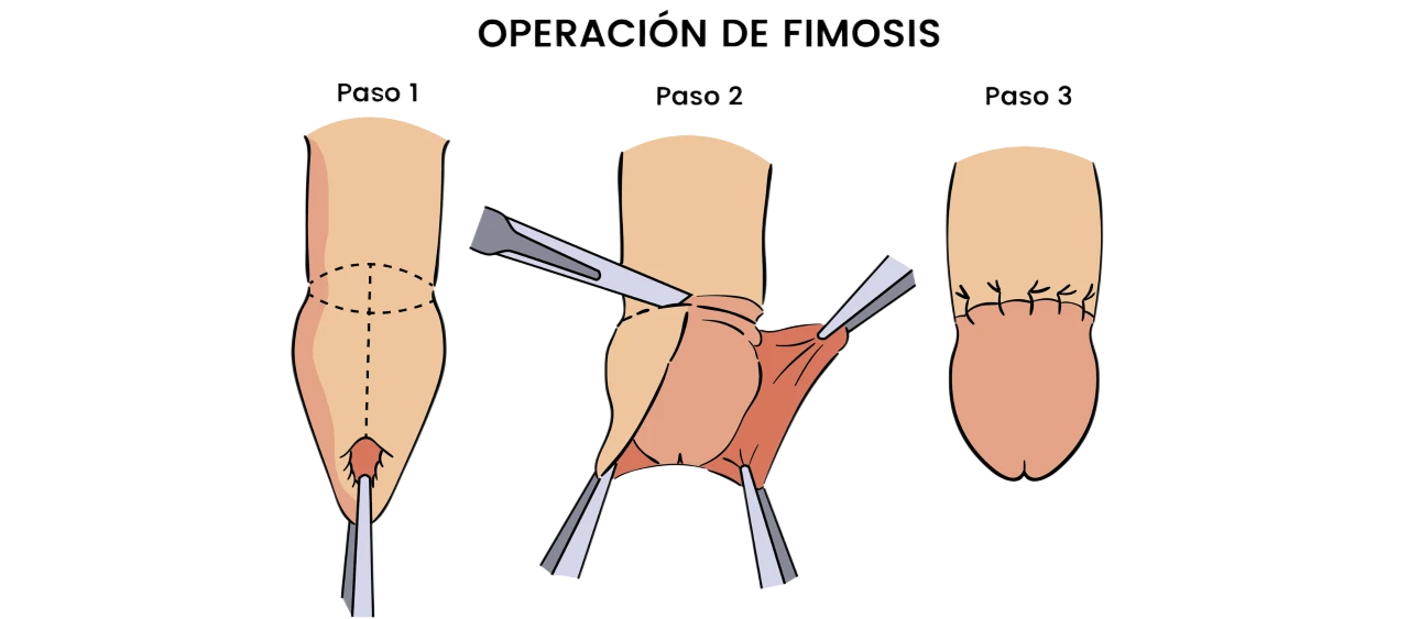 Operación de Circuncision, procedimiento fimosis, frenillo, circuncision @ Dr. Robert Mejia, Cirujano Urólogo en Santo Domingo, República Dominicana.webp